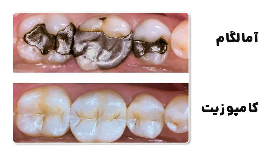 هزینه پر کردن دندان با آمالگام و کامپوزیت