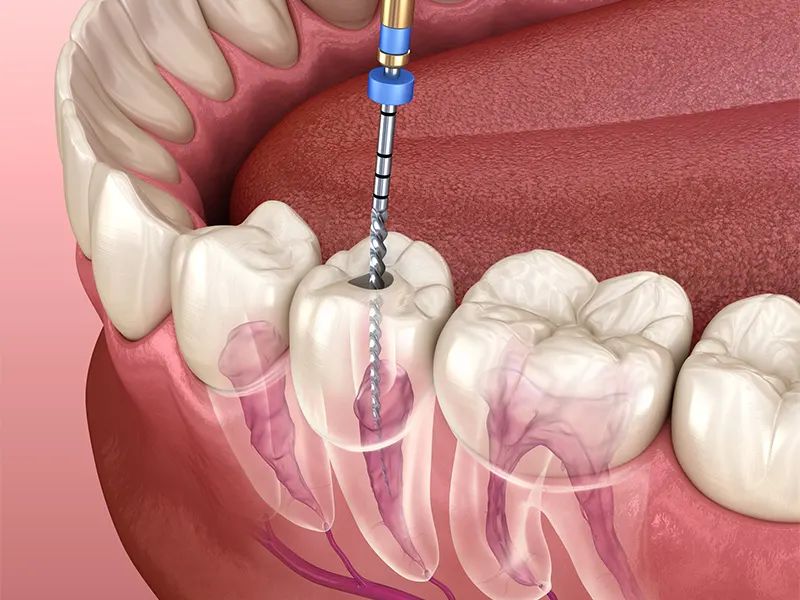 هزینه عصب کشی دندان در غرب تهران