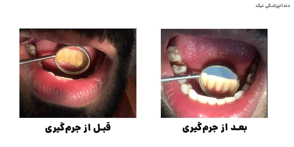 قبل و بعد از جرم گیری دندان