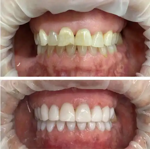 Durability comparison between composite bonding and ceramic veneers