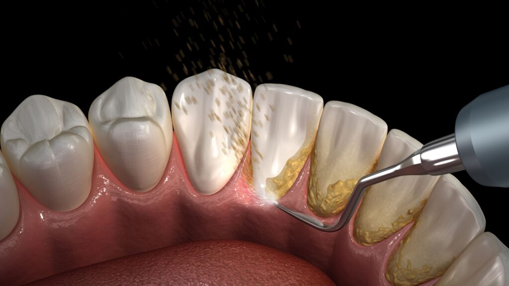 جرم‌گیری دندان در مطب دندانپزشکی