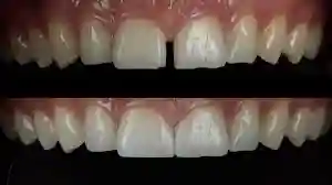 قبل و بعد بستن فاصله بین دندان‌ها با کامپوزیت