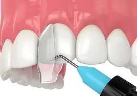 کامپوزیت دندان در مطب نیک سعادت‌آباد با بهترین مواد