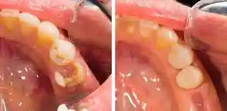 کامپوزیت دندان چیست و چگونه لایه رزینی روی دندان قرار می‌گیرد