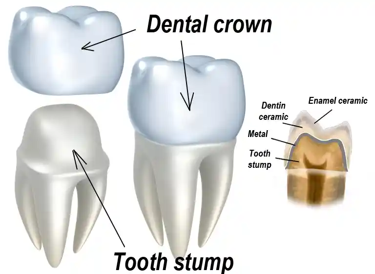 metal ceramic dental crown structure