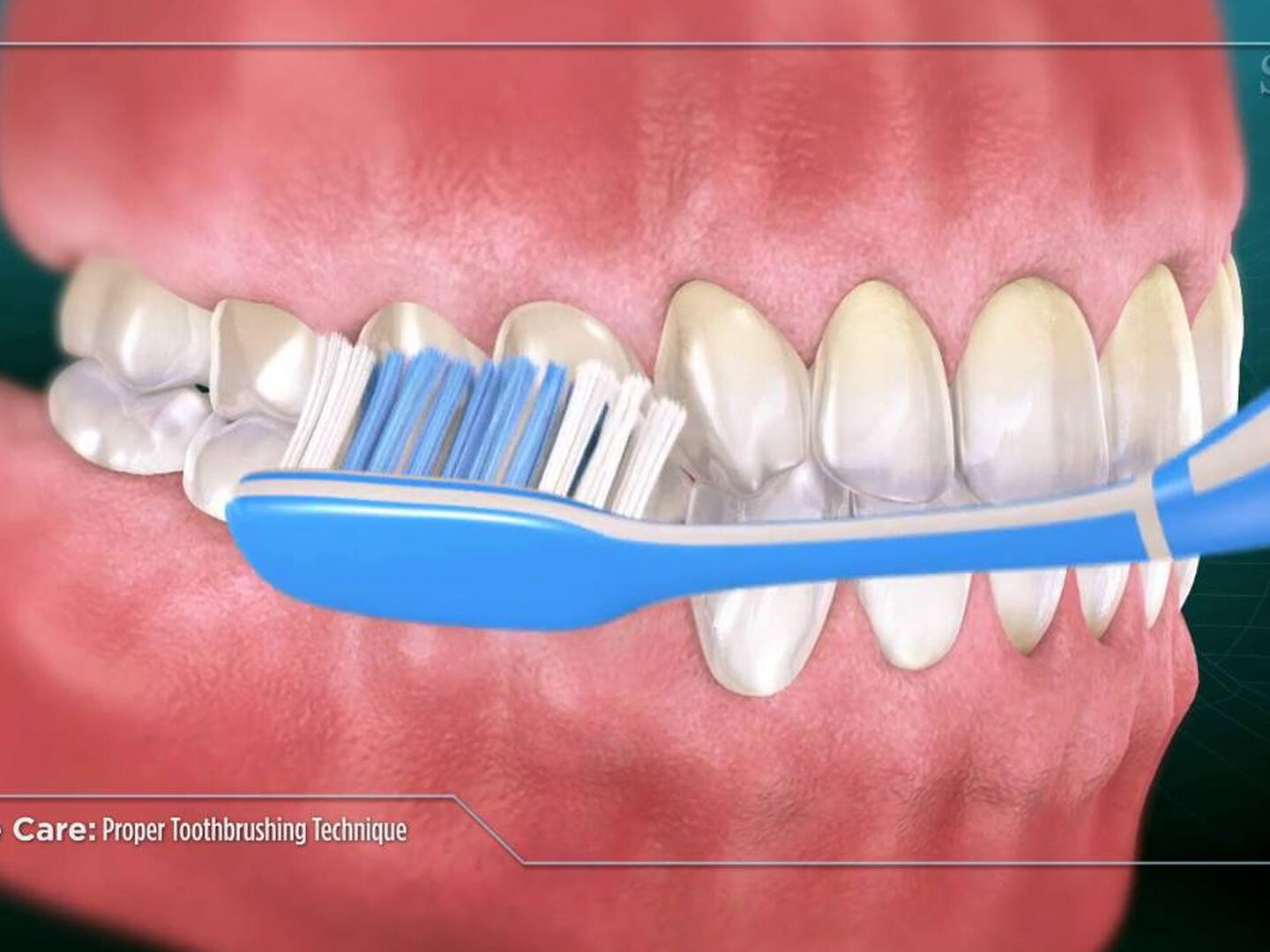 مسواک زدن اصولی برای پیشگیری از پوسیدگی