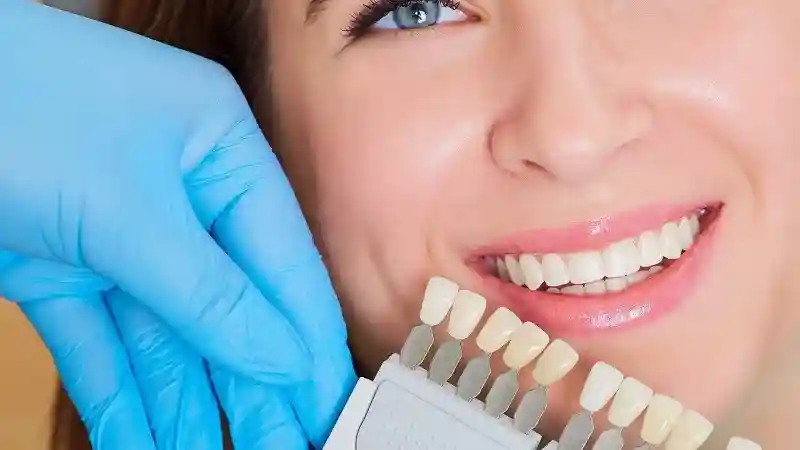 مقایسه مزایای کامپوزیت دندان با لمینت سرامیکی