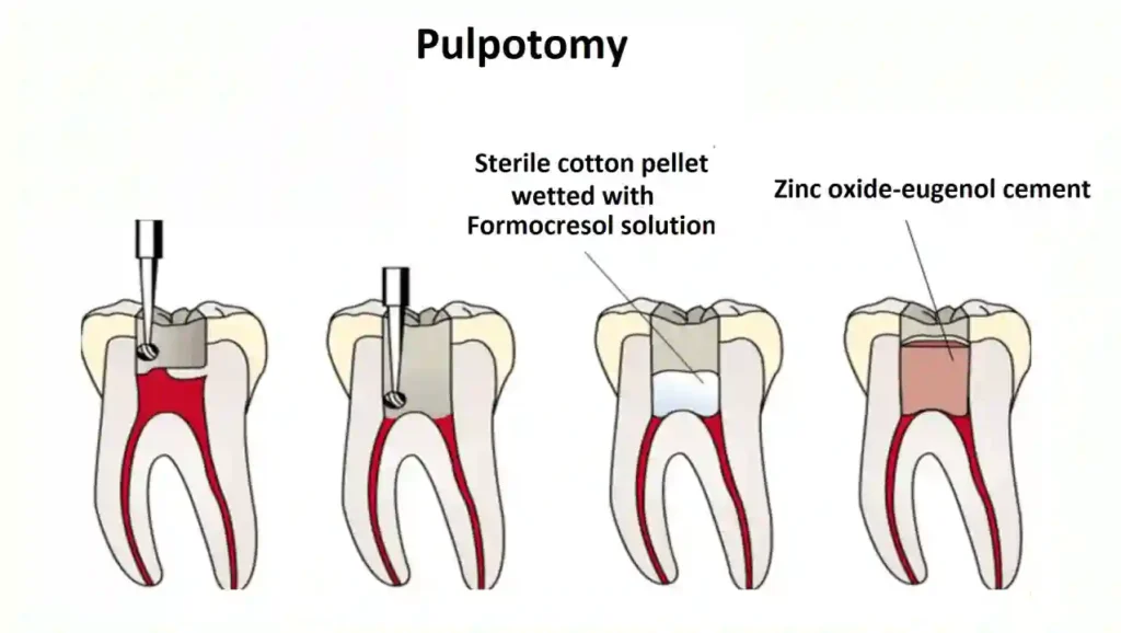مراحل پر کردن دندان شیری