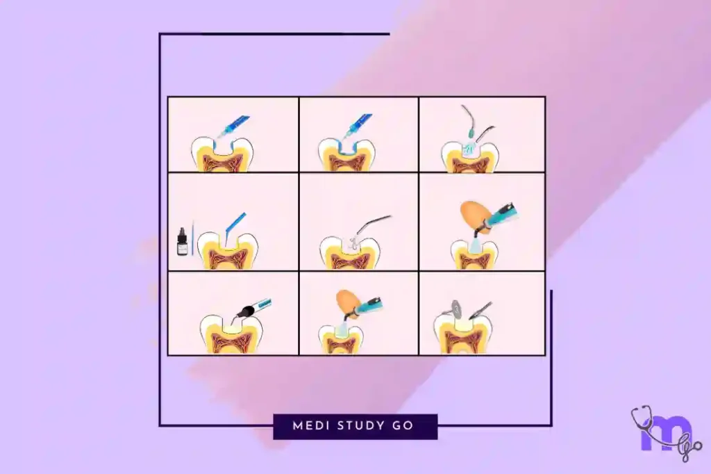 نمودار مراحل انجام کامپوزیت دندان