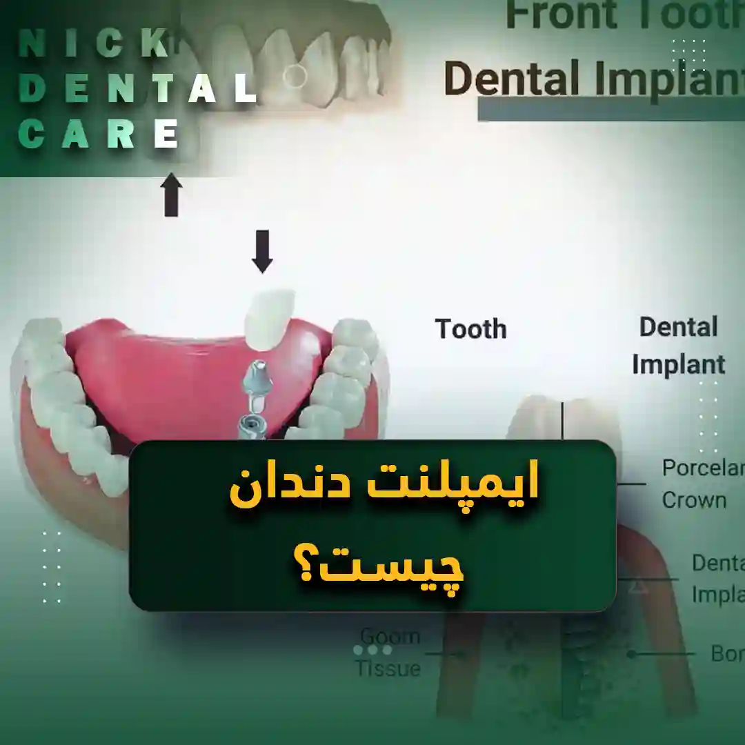 ایمپلنت دندان