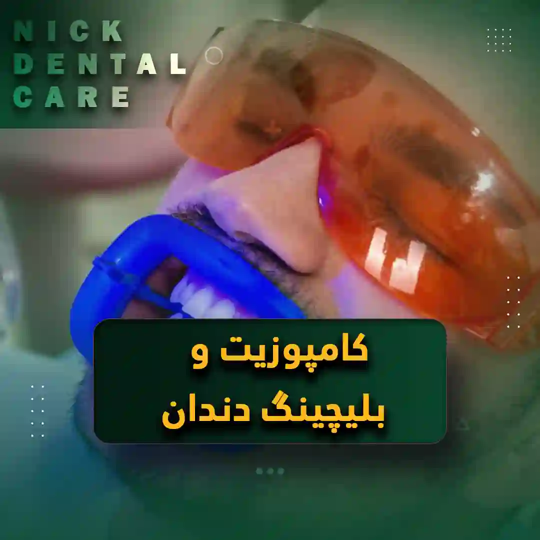 کامپوزیت و بلیچینگ دندان