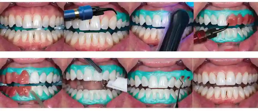 مراحل انجام بلیچینگ حرفه‌ای