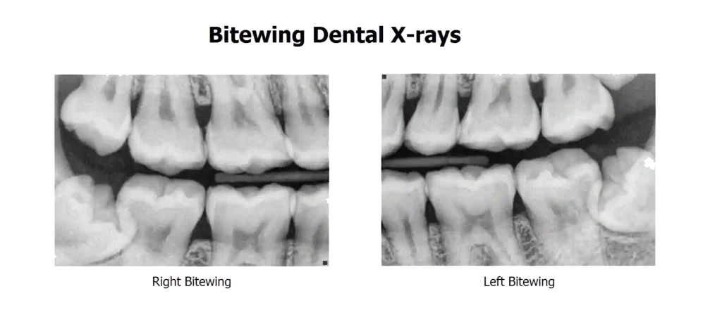 رادیوگرافی دندان شیری کودک پس از ضربه