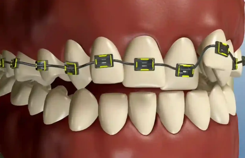 ارتودنسی ثابت با براکت فلزی در مطب نیک سعادتآباد