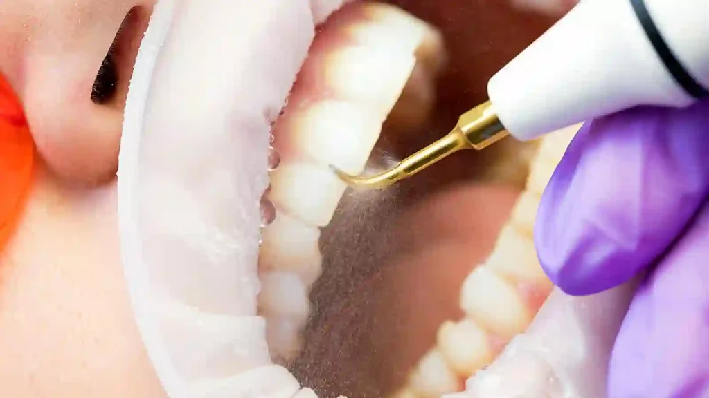 حذف جرم دندان با دستگاه اولتراسونیک