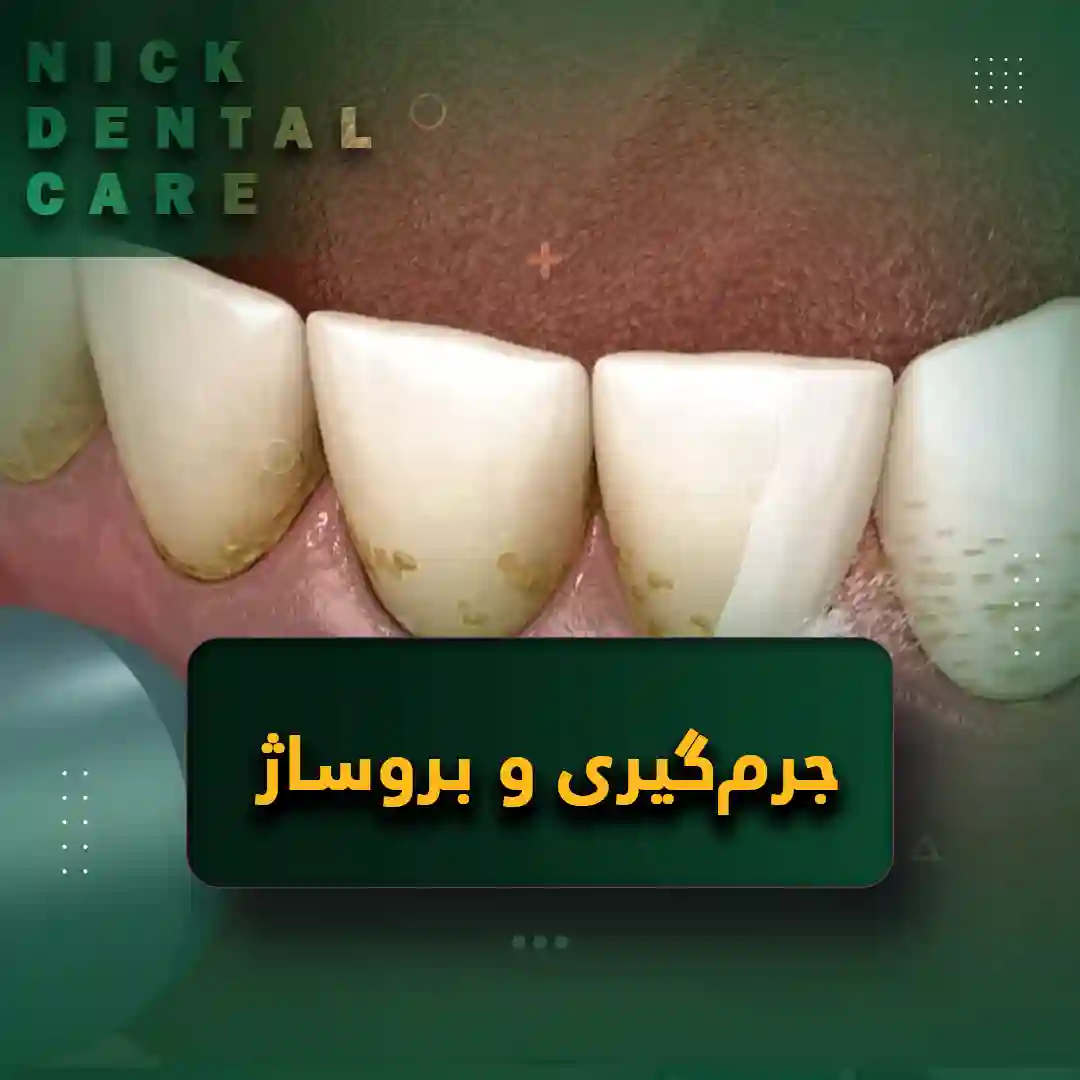 جرم‌گیری و بروساژ