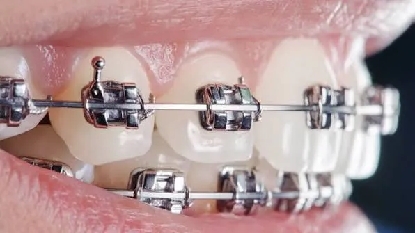 ارتودنسی ثابت- مطب نیک سعادت آباد