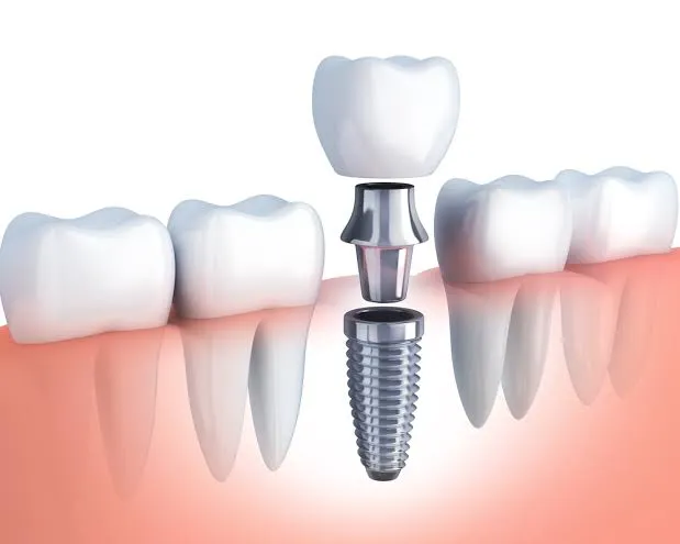 ایمپلنت دندان- مطب نیک سعادت آباد