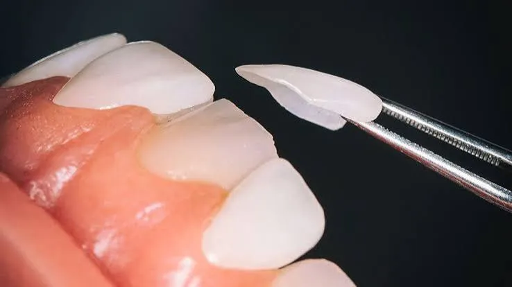 لمینت دندان چیست؟ - مطب نیک سعادت آباد