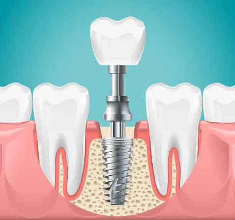 مزایای ایمپلنت دندان در مطب نیک سعادت آباد