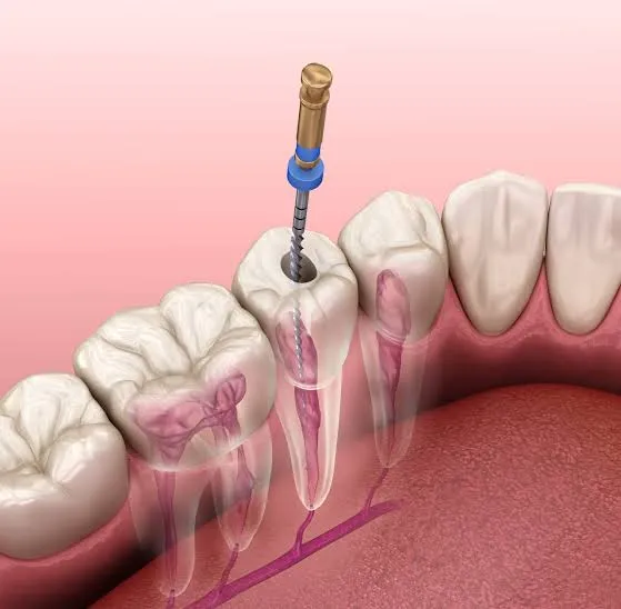 همه چیز درباره موفقیت عصب‌کشی