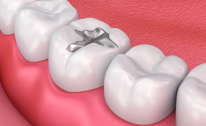 پر کردن دندان - مطب نیک در سعادت آباد