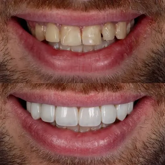 کامپوزیت دندان در مطب نیک سعادت آباد