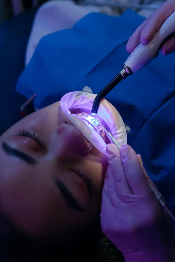 بلیچینگ دندان در مطب با نور مخصوص برای فعال‌سازی ژل سفیدکننده